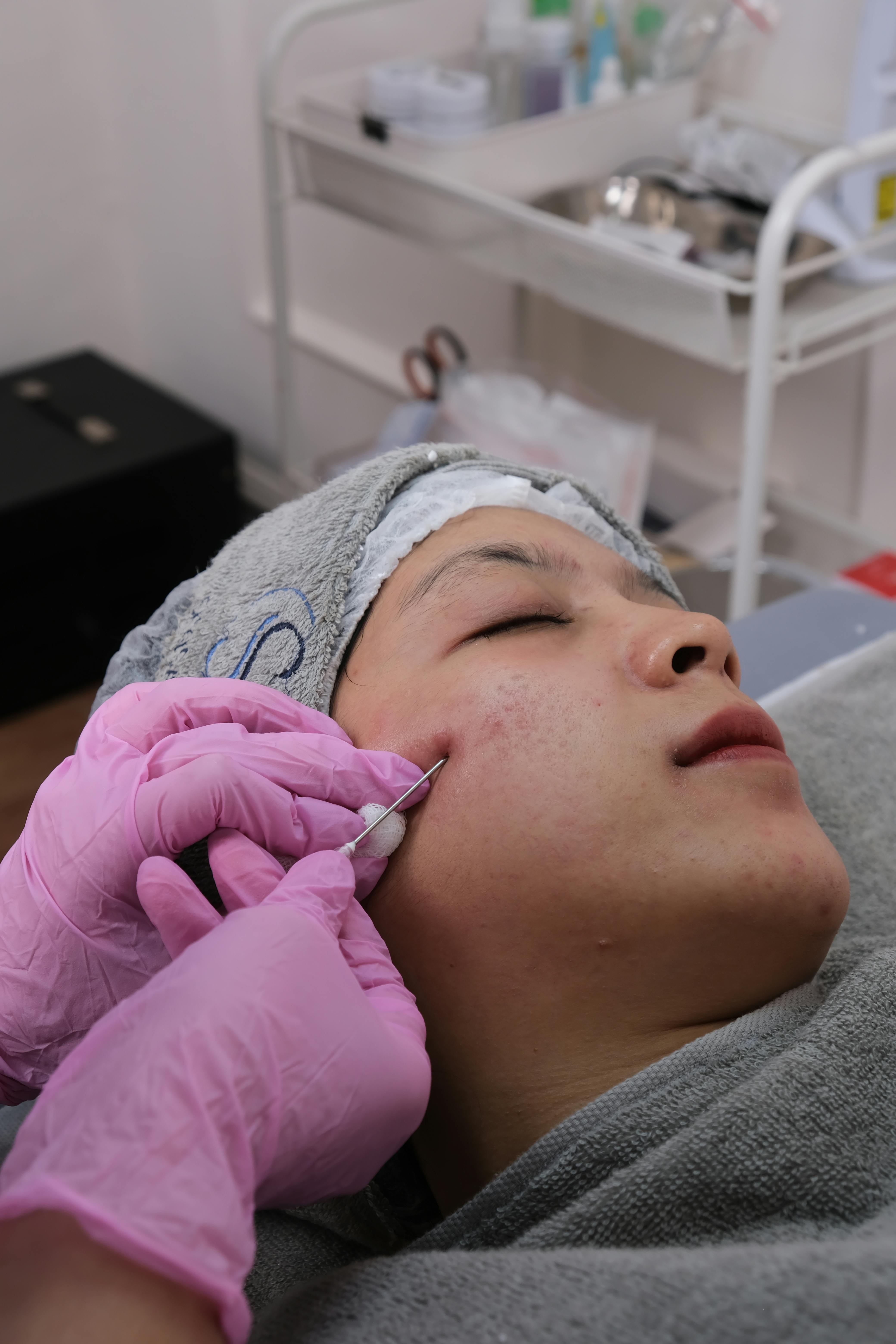 Sess&atilde;o de microagulhamento facial em ambiente cl&iacute;nico